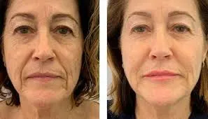 HIFU facial: lifting sin cirugía con precisión clínica